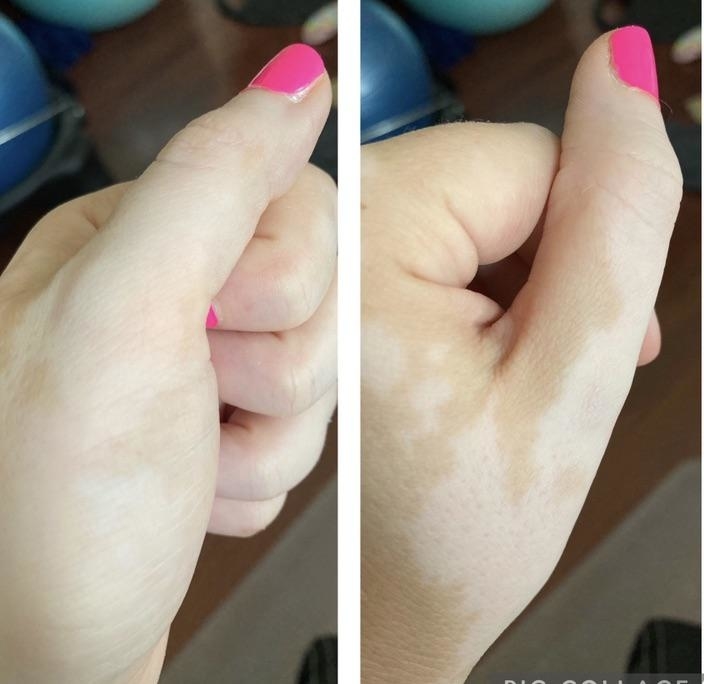 A depigmented thumb