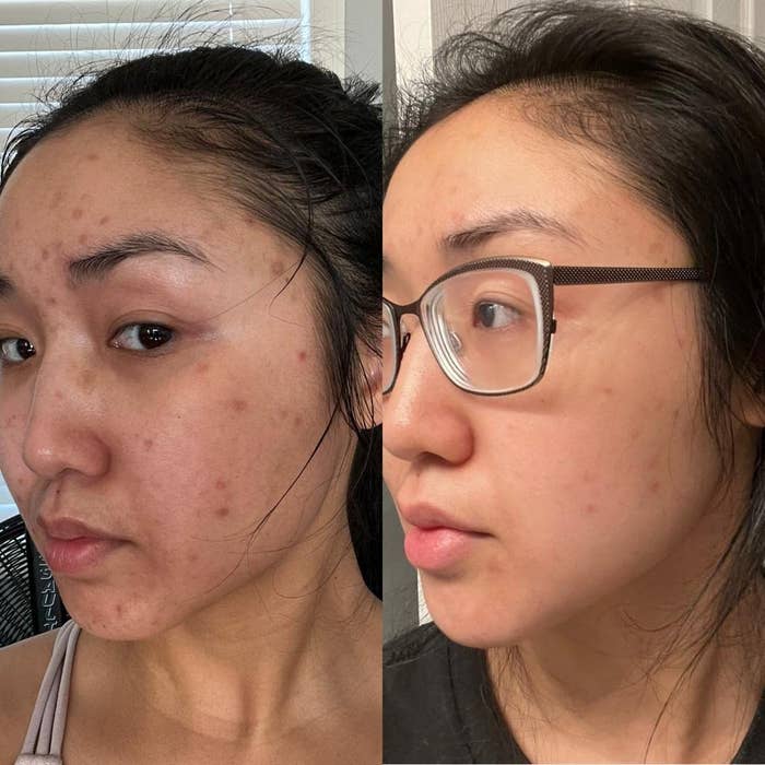 reviewer&#x27;s before and after of their skin having small spots/scars on it compared to three weeks later with most of the spots faded or gone