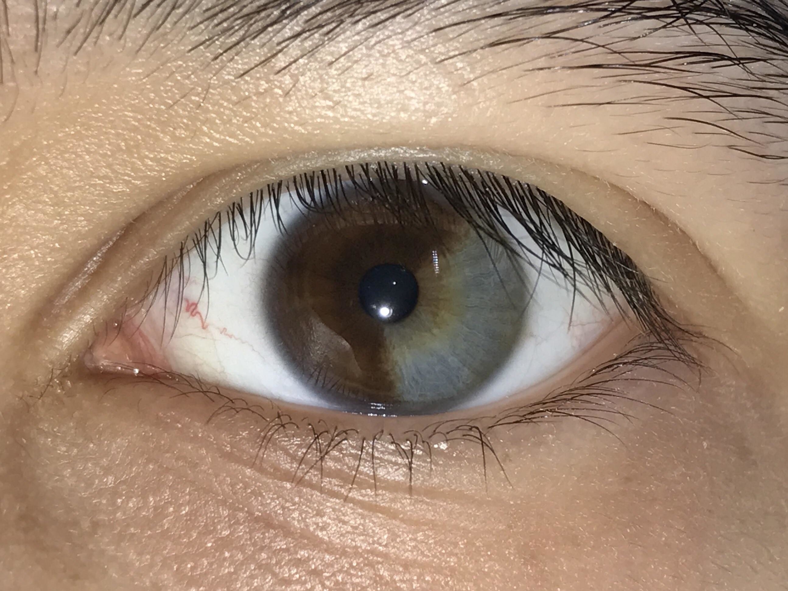 An eye with heterochromia