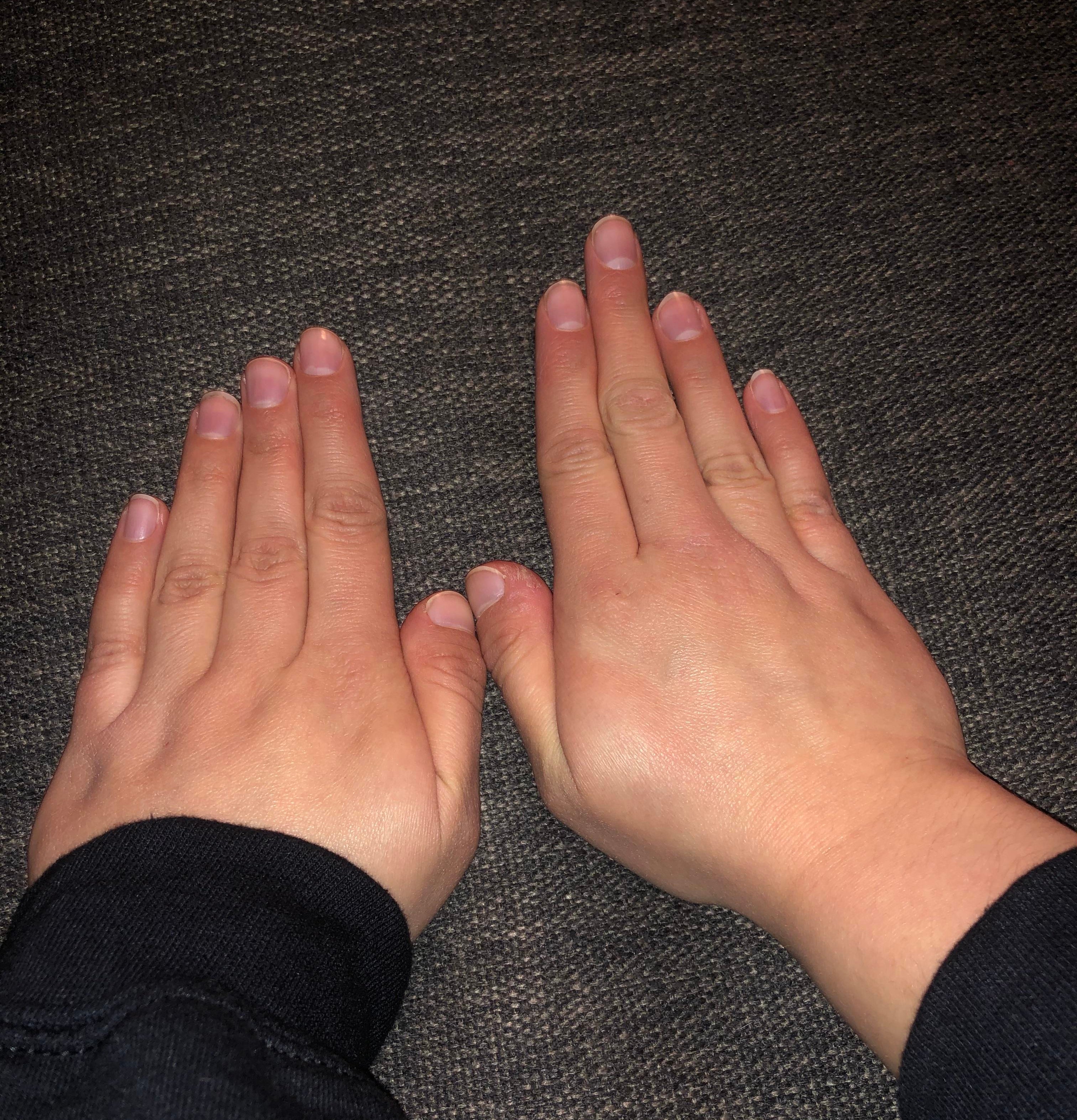 A person with two different sets of fingers