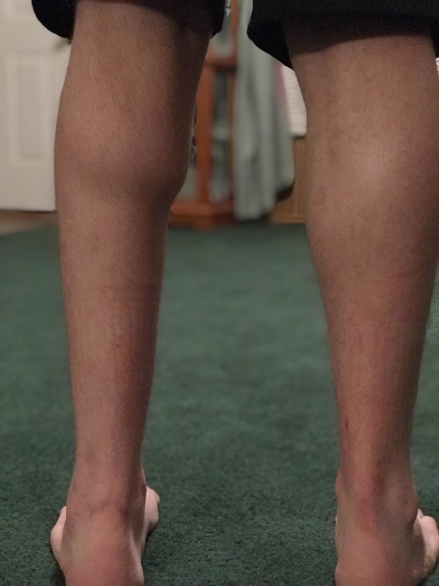 One leg with a severed Achilles tendon