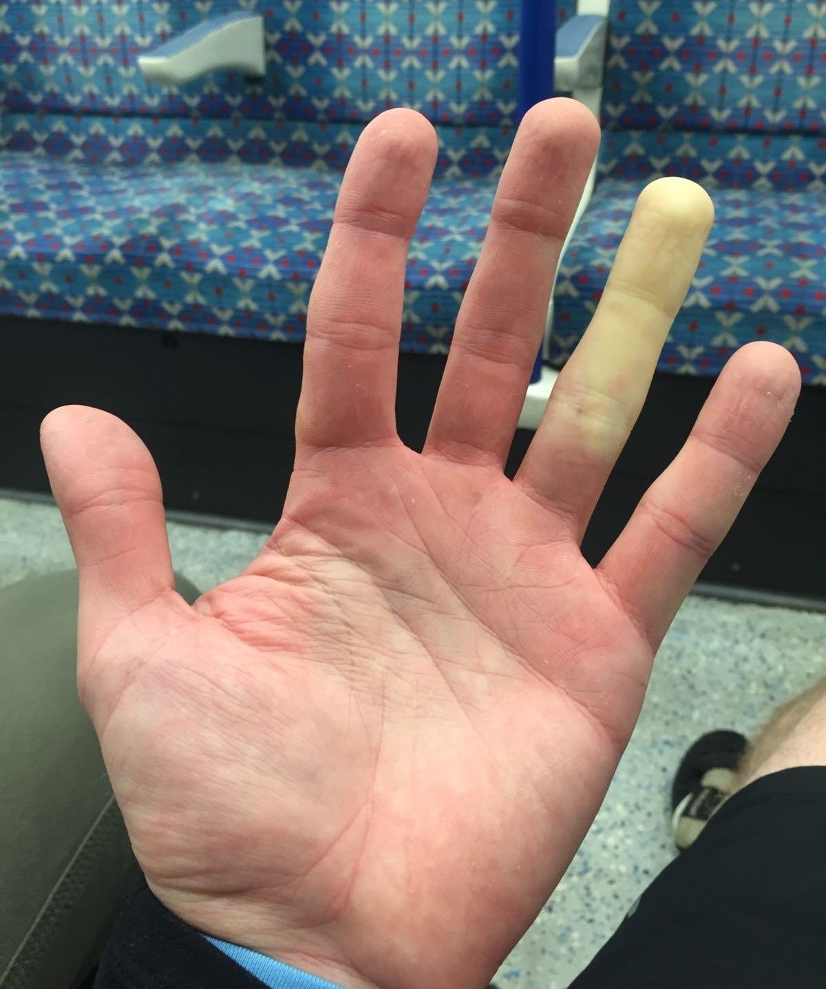A finger with Raynaud&#x27;s Phenomenon