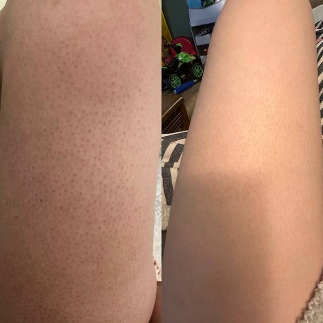 a before and after photo of a reviewer with strawberry legs and the same review but the strawberry legs have faded