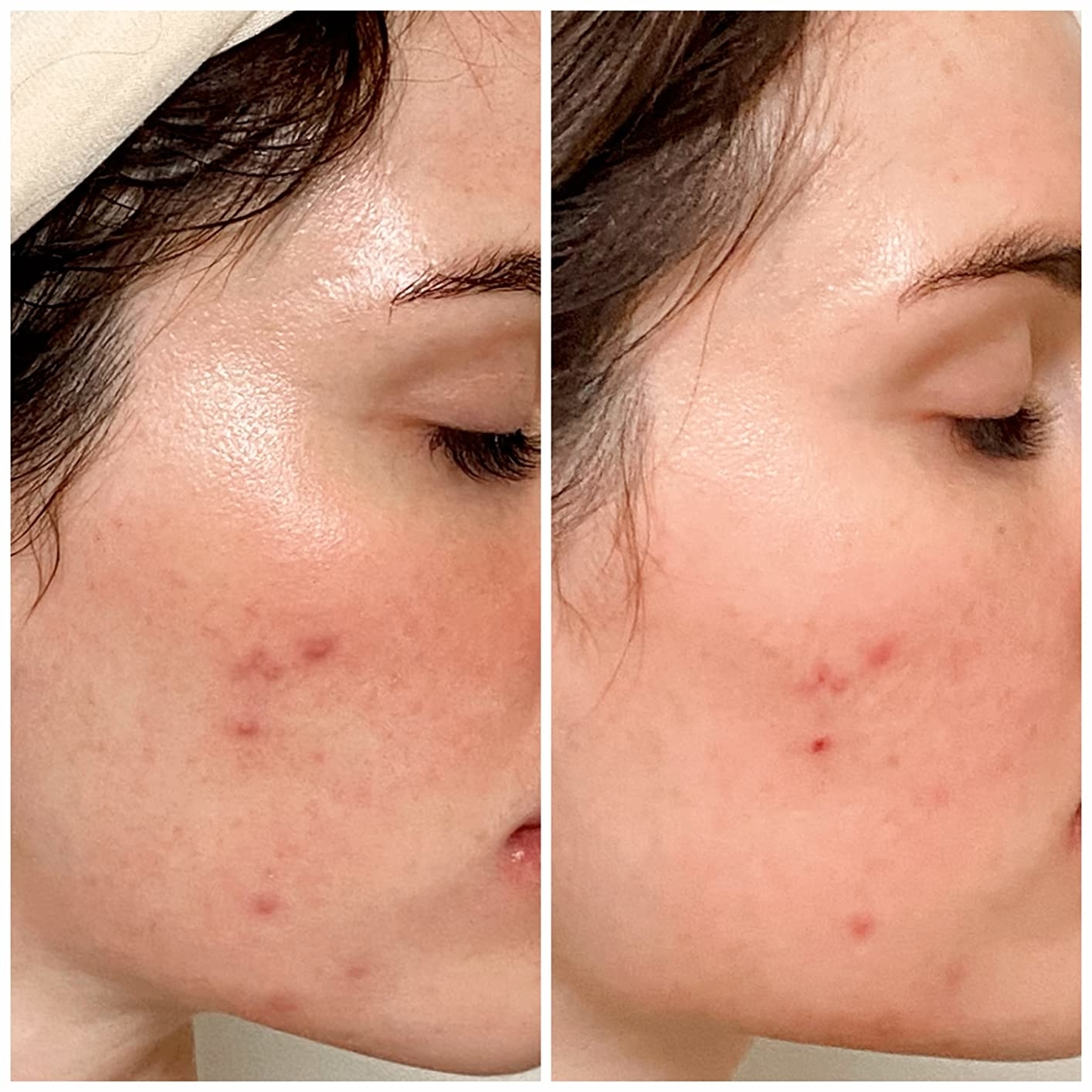 two reviewer photo 12 hours apart showing the oil helped reduce redness and helped heal breakouts overnight