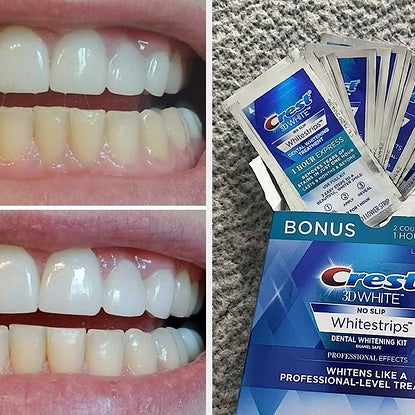 Hello, Pearly Whites — Crest Whitestrips Are Luckily On Sale For Prime Day