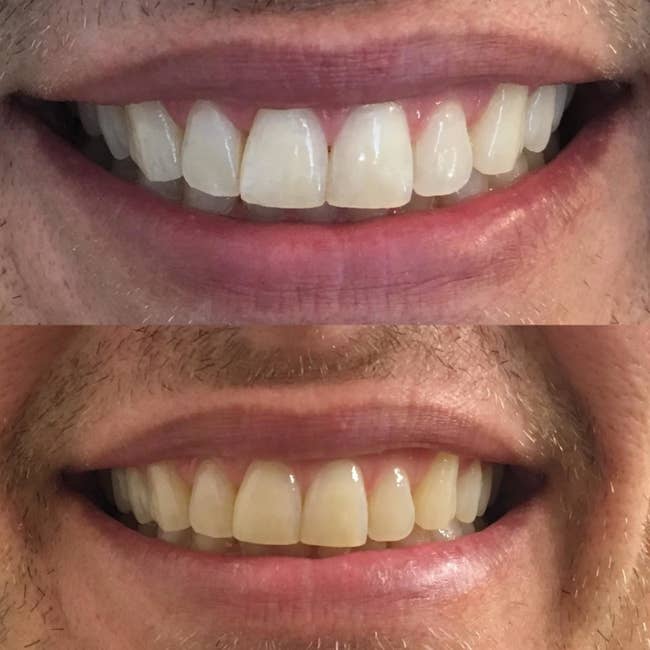 a before and after photo of a reviewer's teeth going from yellow to white, when using crest 3D white strips