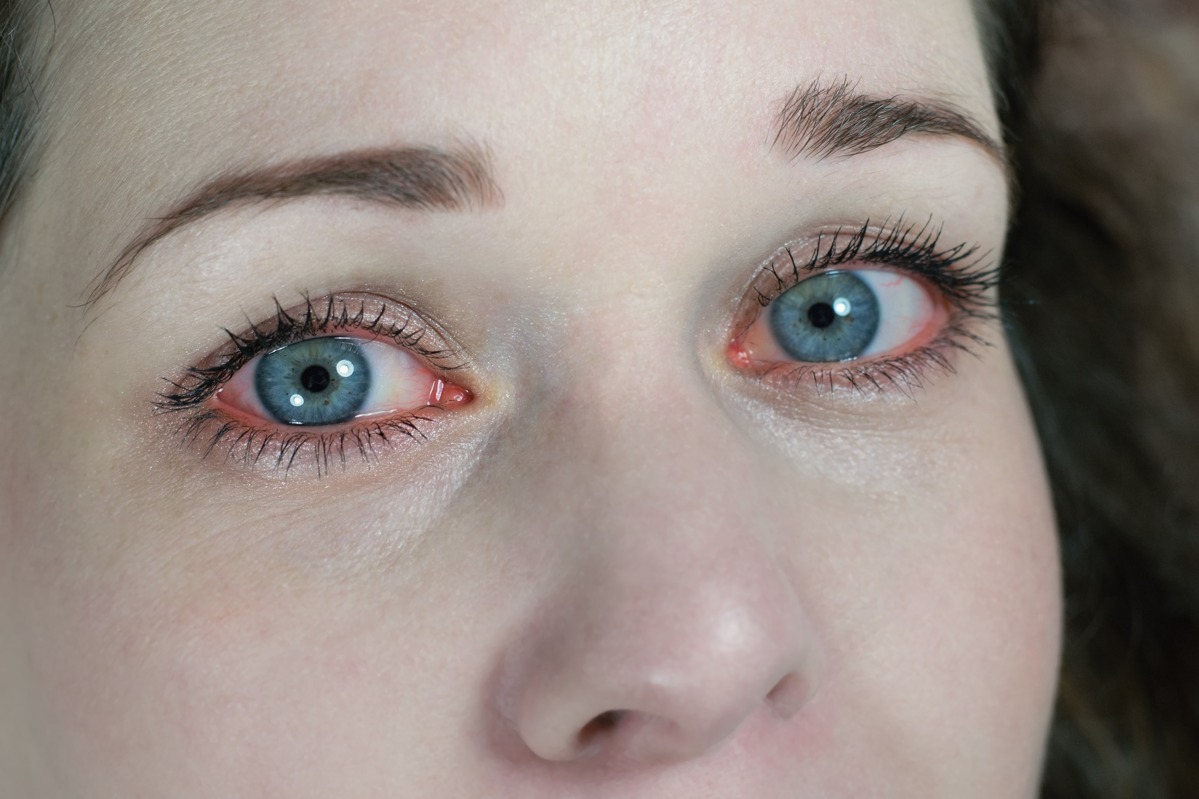 An image of a woman&#x27;s blue eyes with red rims