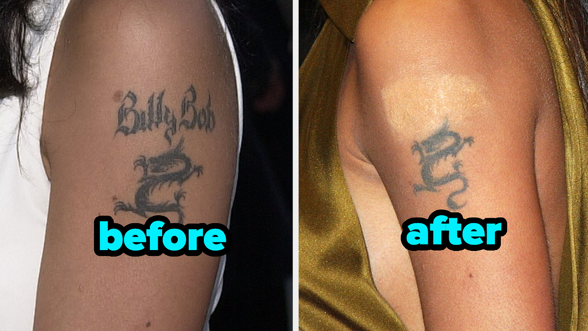The Gold Standard Treatment For Tattoo Removal