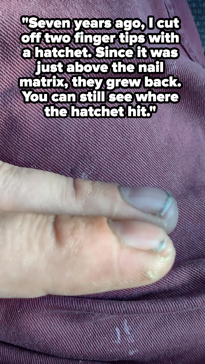 Caption saying that they cut off their two fingertips with a hatchet seven years ago and they grew back because it was just above the nail matrix, with an image of two fingers, with a slight ridge around the nail bed