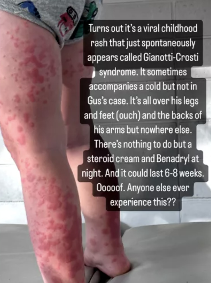 A closeup of a red rash all over a child&#x27;s legs