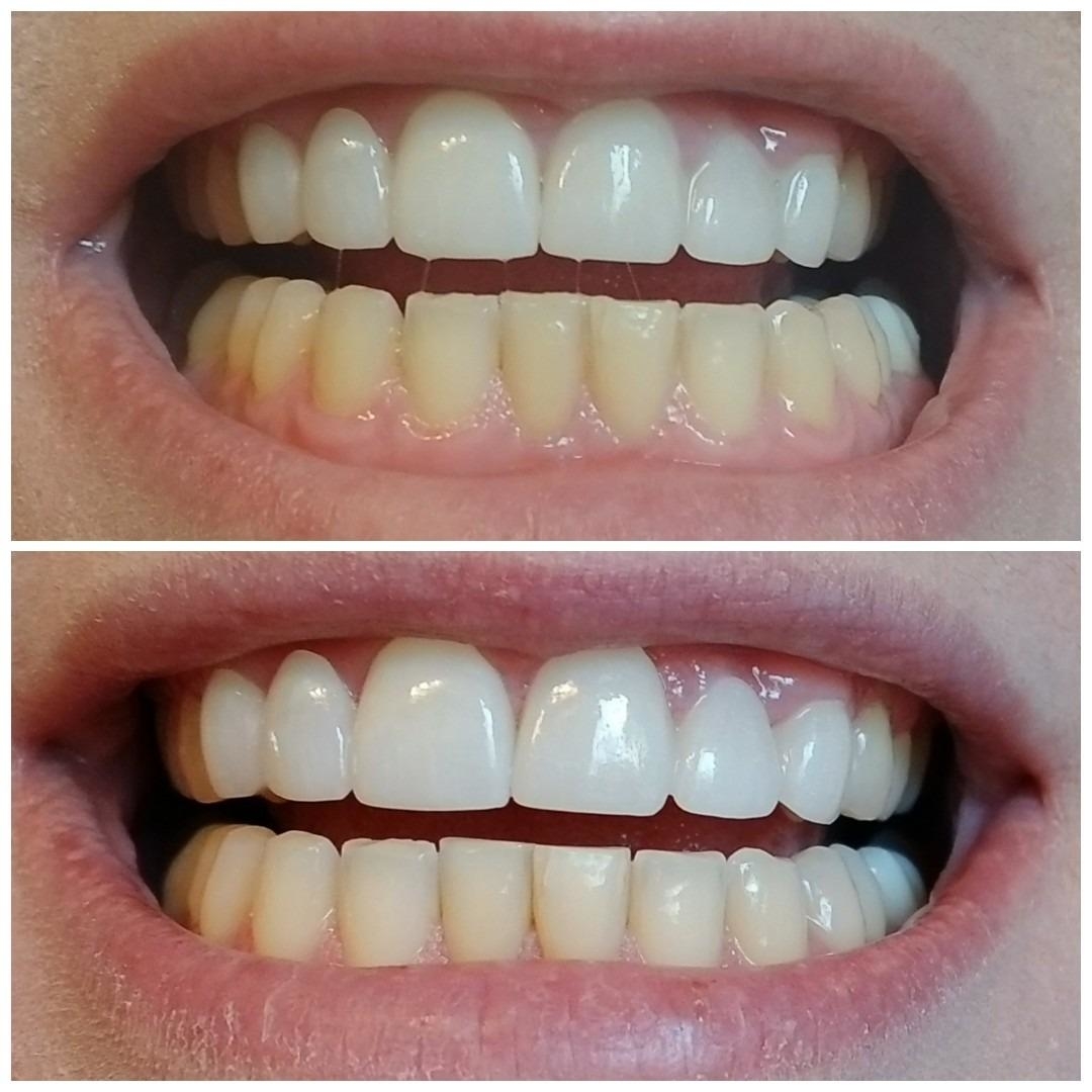 reviewer&#x27;s teeth before and after the whitening strips showing the strips significantly lightened their yellowed teeth