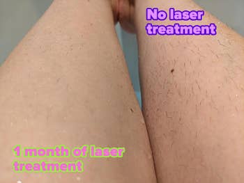 Reviewer with before and after results of using laser for one month