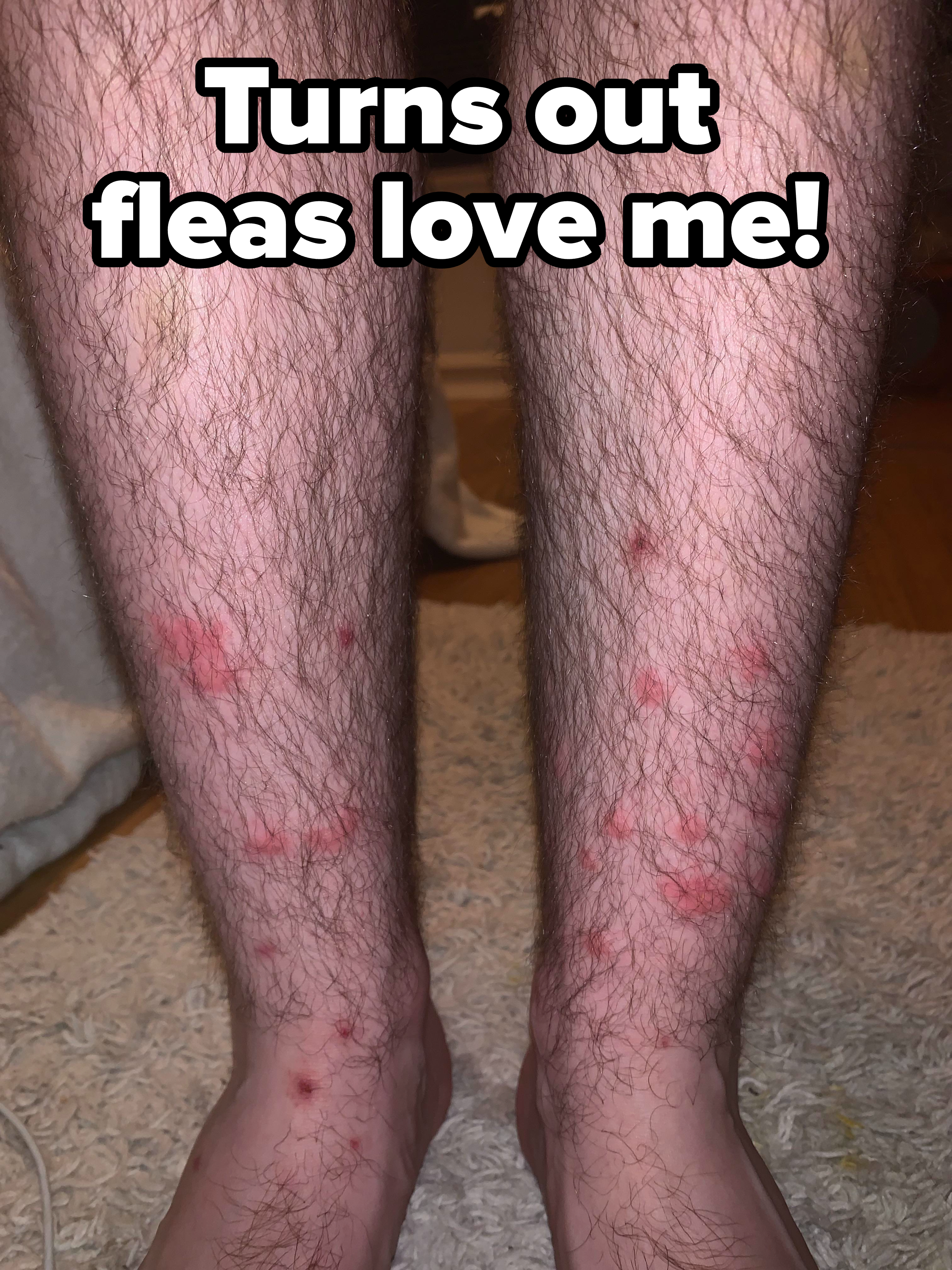flea bites on legs