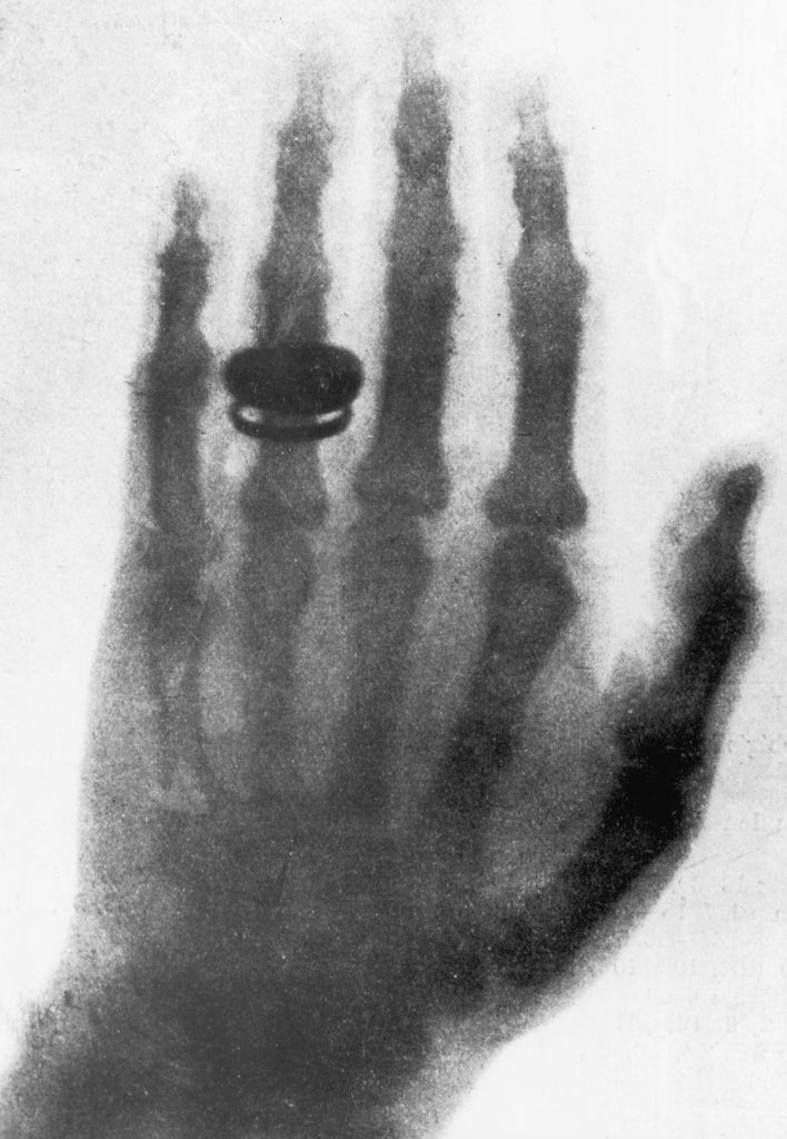 A ghostly X-ray of a hand held up and showing the bones under the skin and a ring on one finger