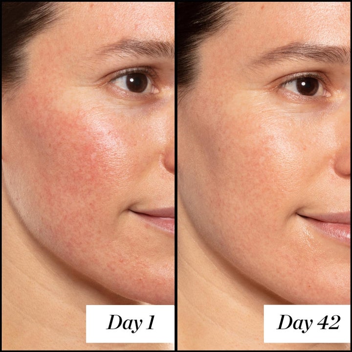 model with red on cheeks, same model 42 days later with redness faded