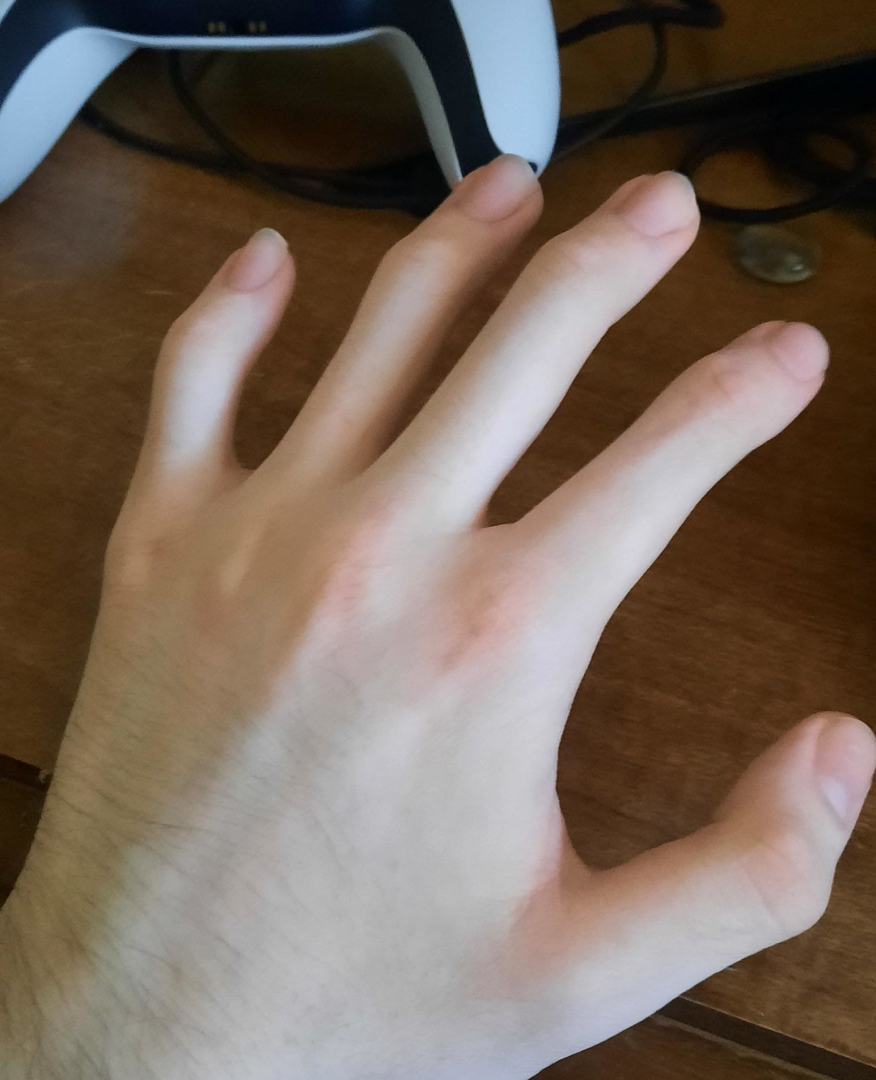 A hand missing middle knuckles