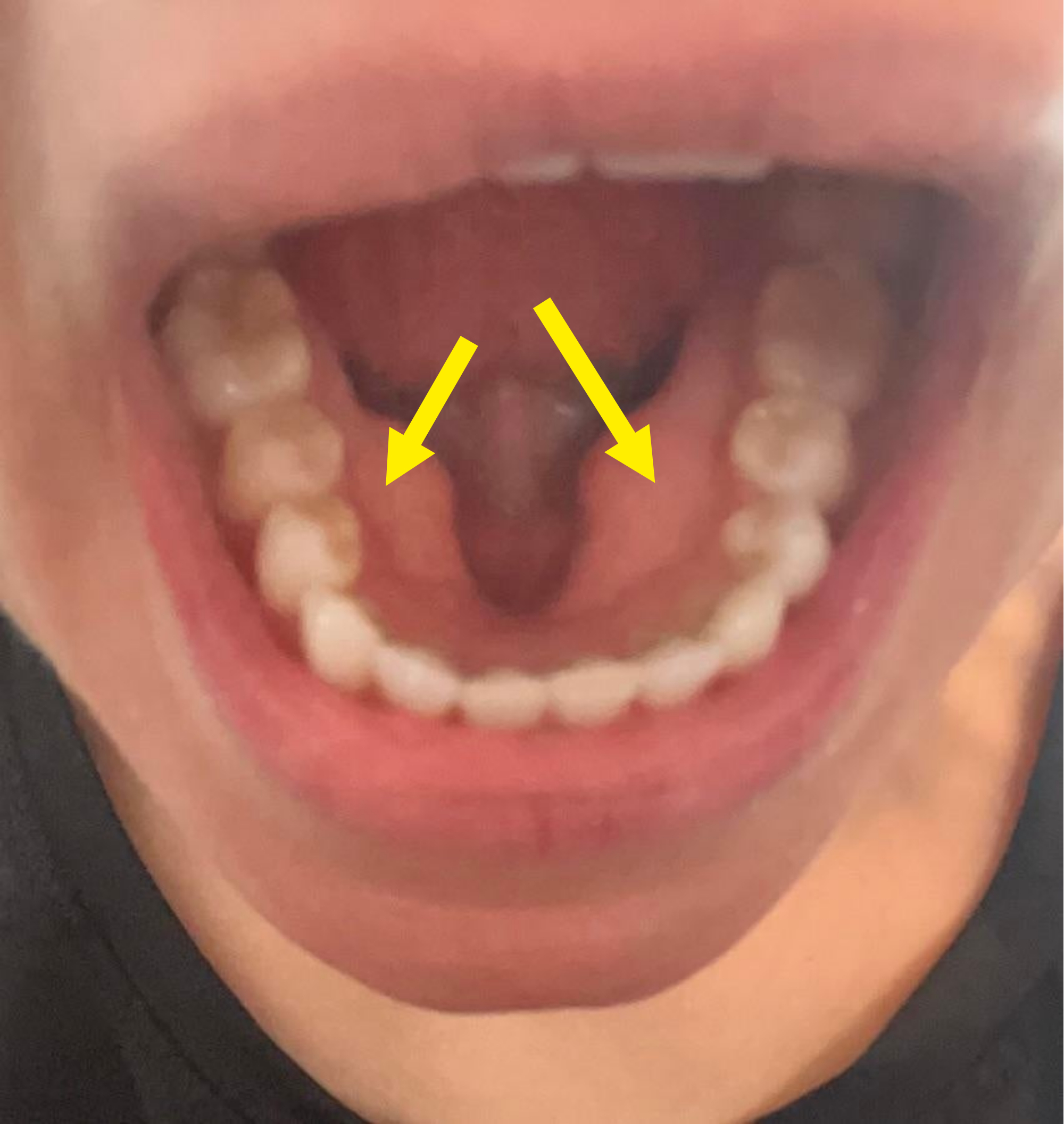A mouth with mandibular tori