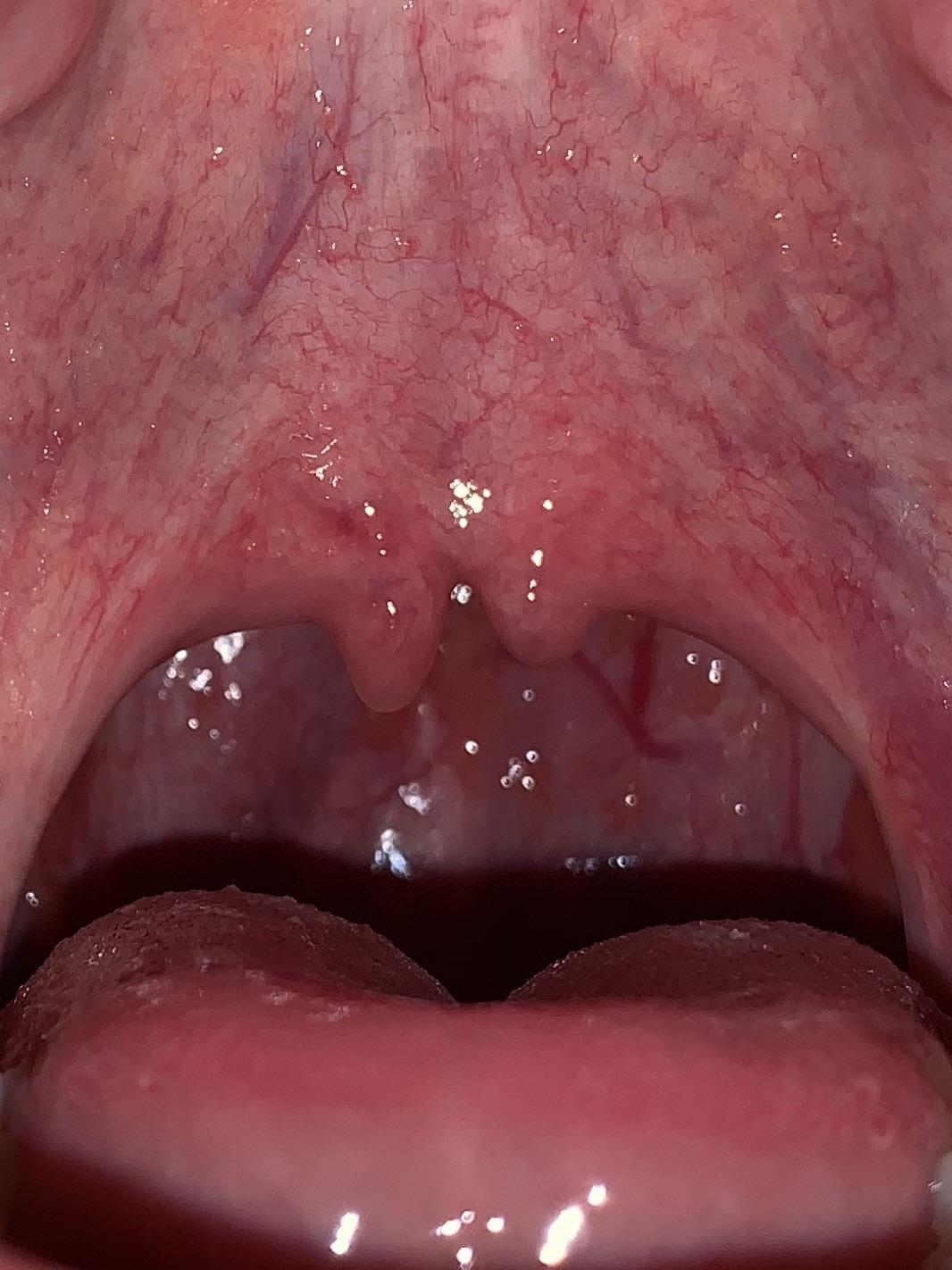 A split uvula in someone&#x27;s mouth