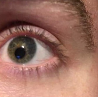 An eye with an off-center pupil