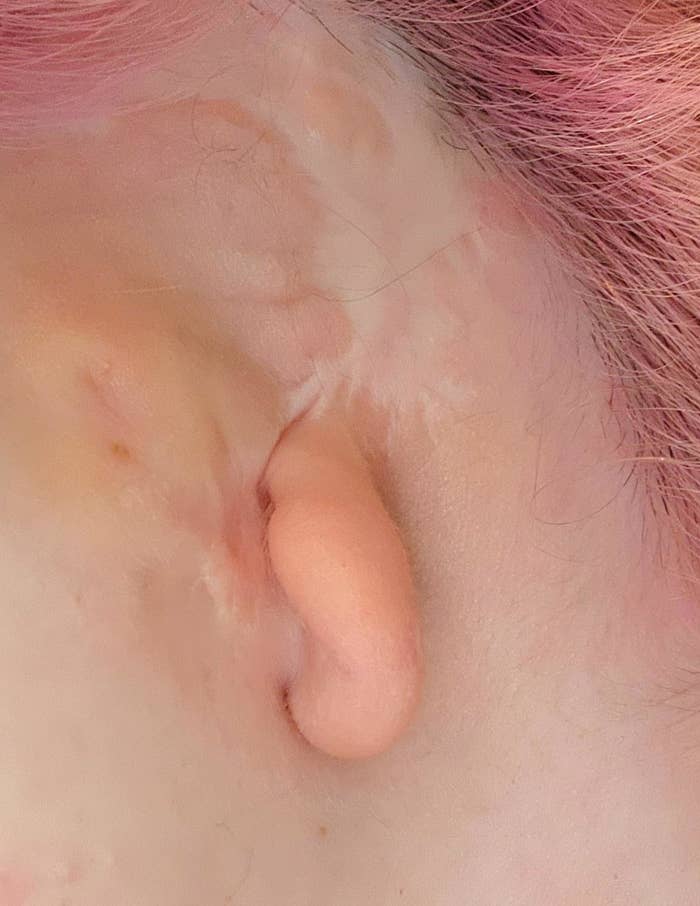 Closeup of someone&#x27;s ear with microtia