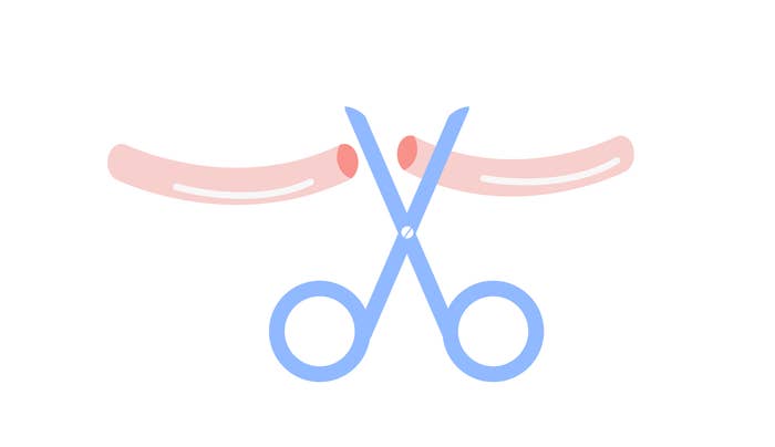 An illustration of a vasectomy