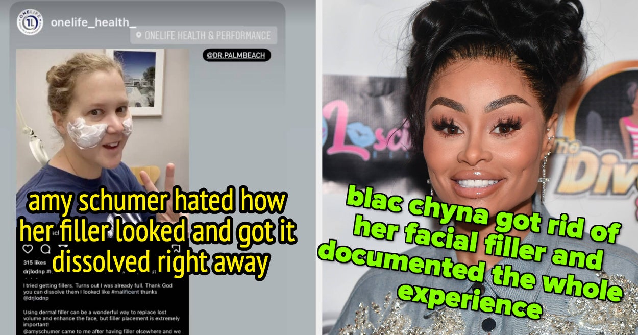 19 Famous People Who Were Candid About Their Experiences With Cosmetic Injectables And Filler