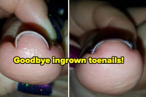 before and after showing a reviewer's toenail now straight