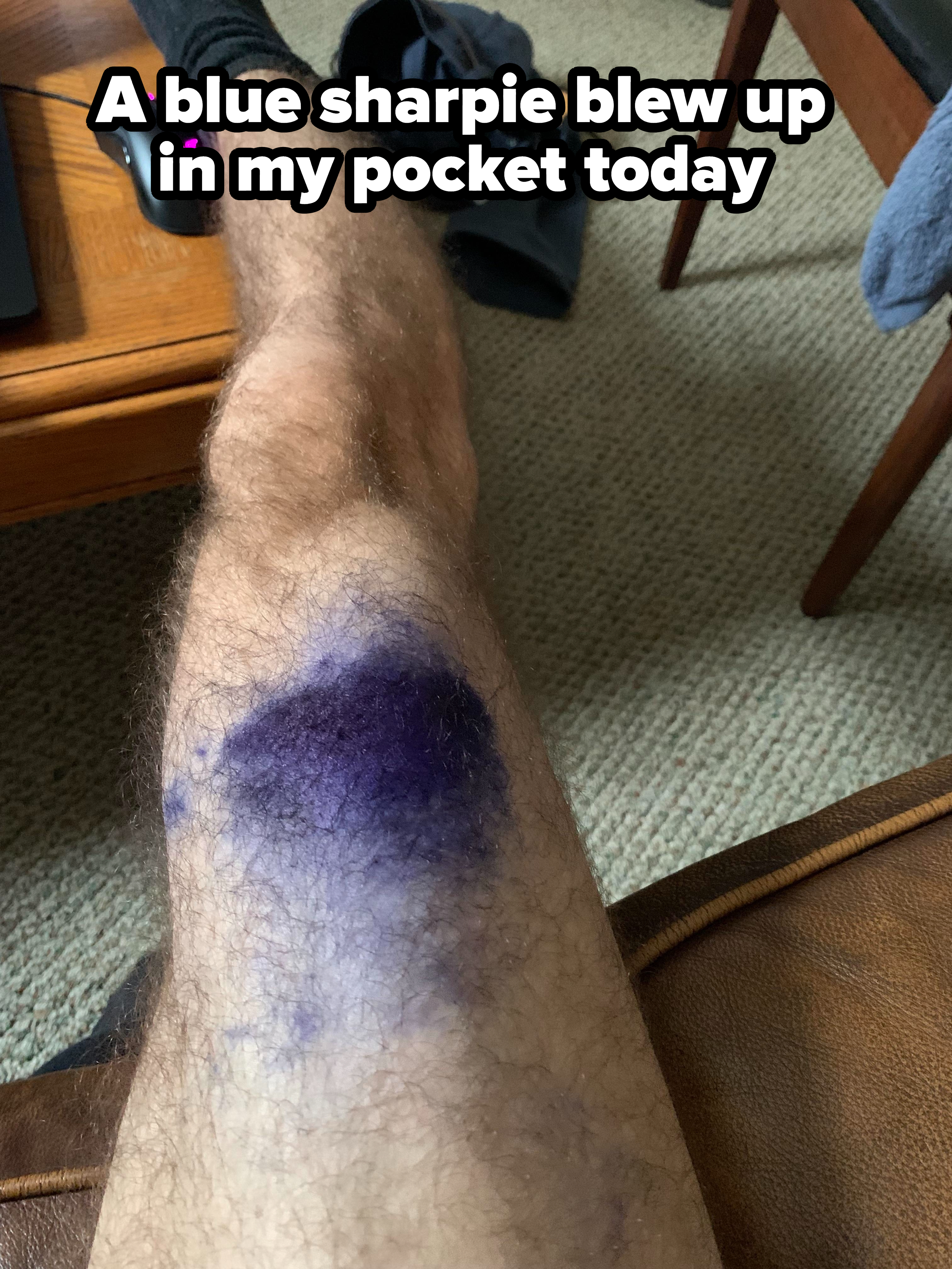 A person&#x27;s knee covered in blue Sharpie