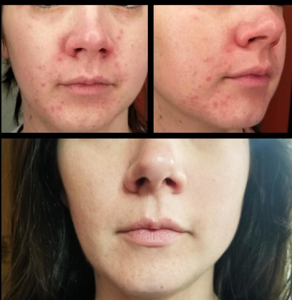 a split before and after image of a reviewer with acne around their chin and the acne cleared up