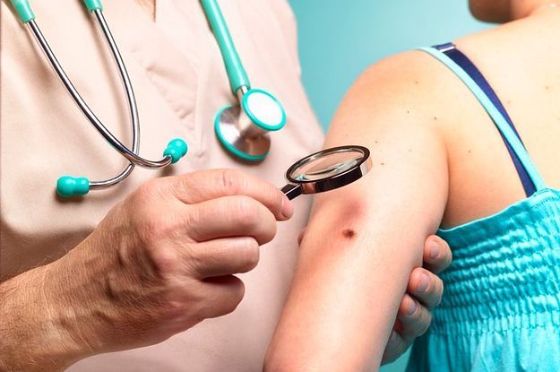 If Your Mole Looks Like This, It's Time To See A Dermatologist - Vimarsana News