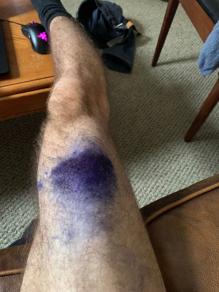 A person&#x27;s knee covered in blue Sharpie