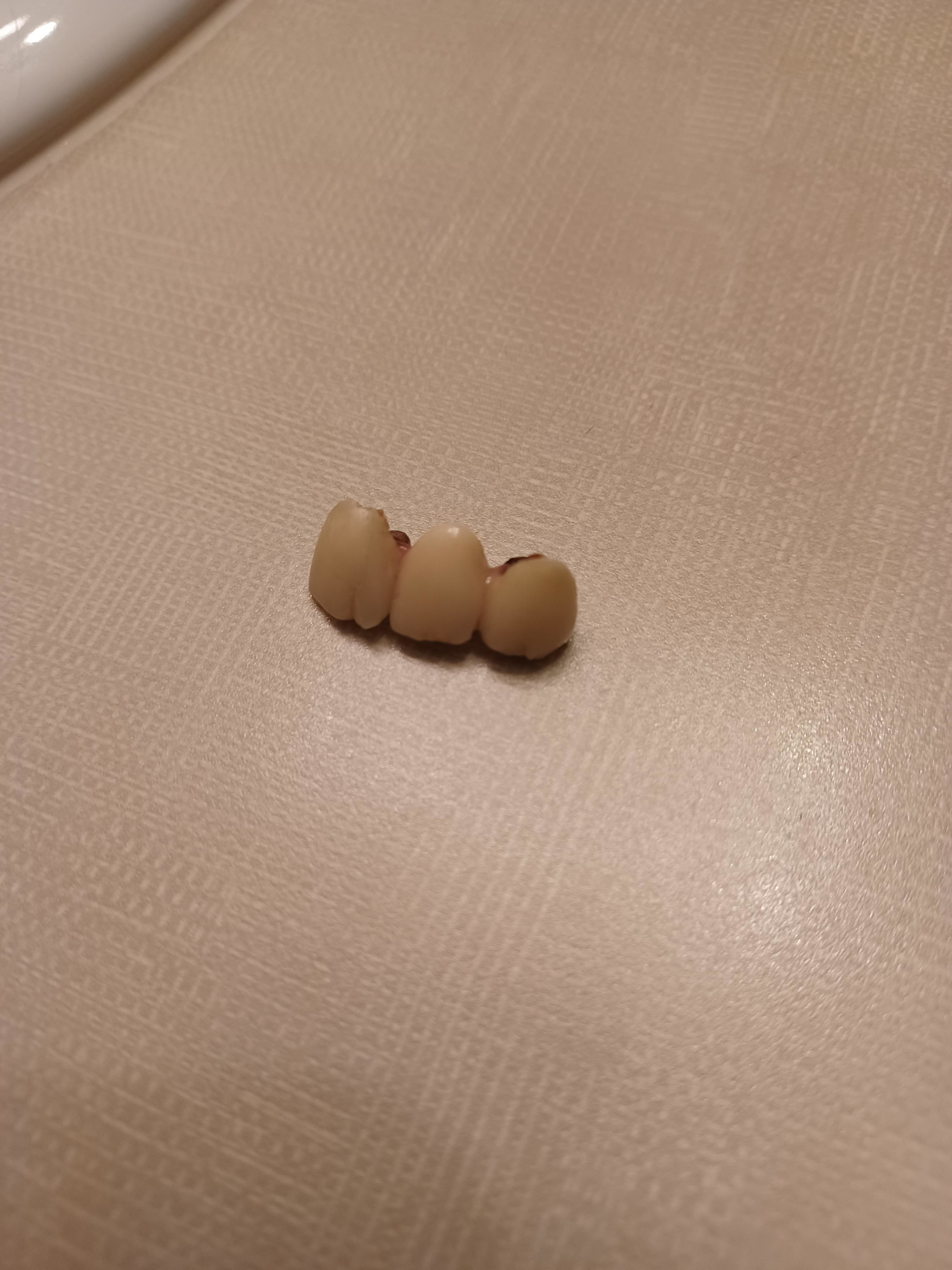 Broken teeth