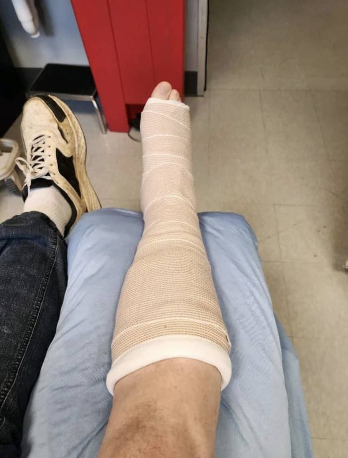 A broken leg