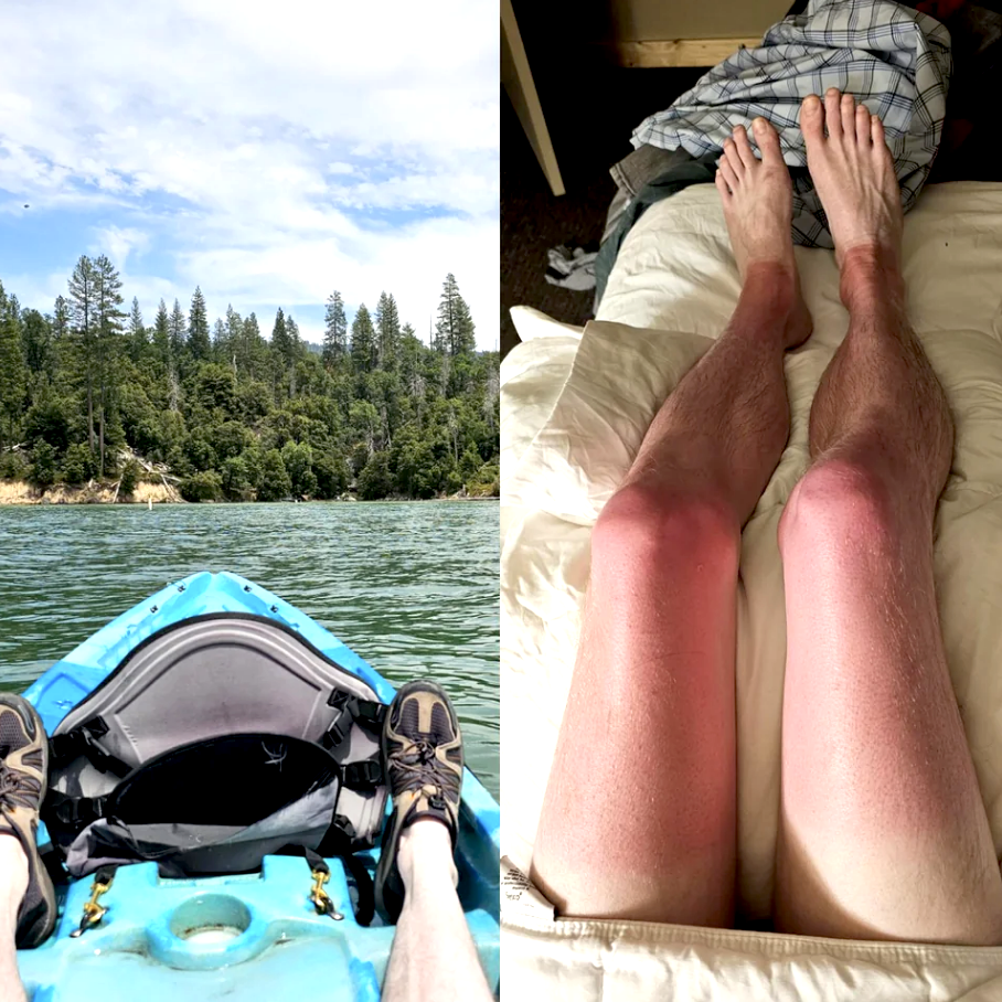 A person on a kayak on the left and then another image on the right of their legs completely sunburnt