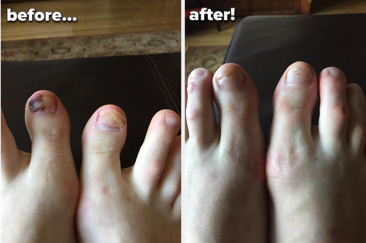 Reviewer&#x27;s big toes with dark and light spots of fungal growth before. The toenails are growing back and looking healthier after use.