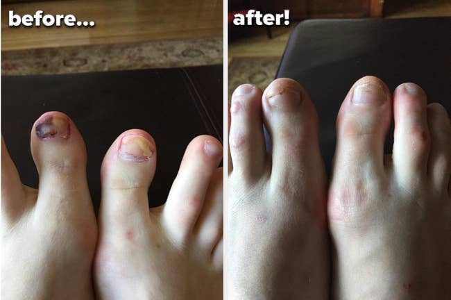 Reviewer's big toes with dark and light spots of fungal growth before. The toenails are growing back and looking healthier after use.