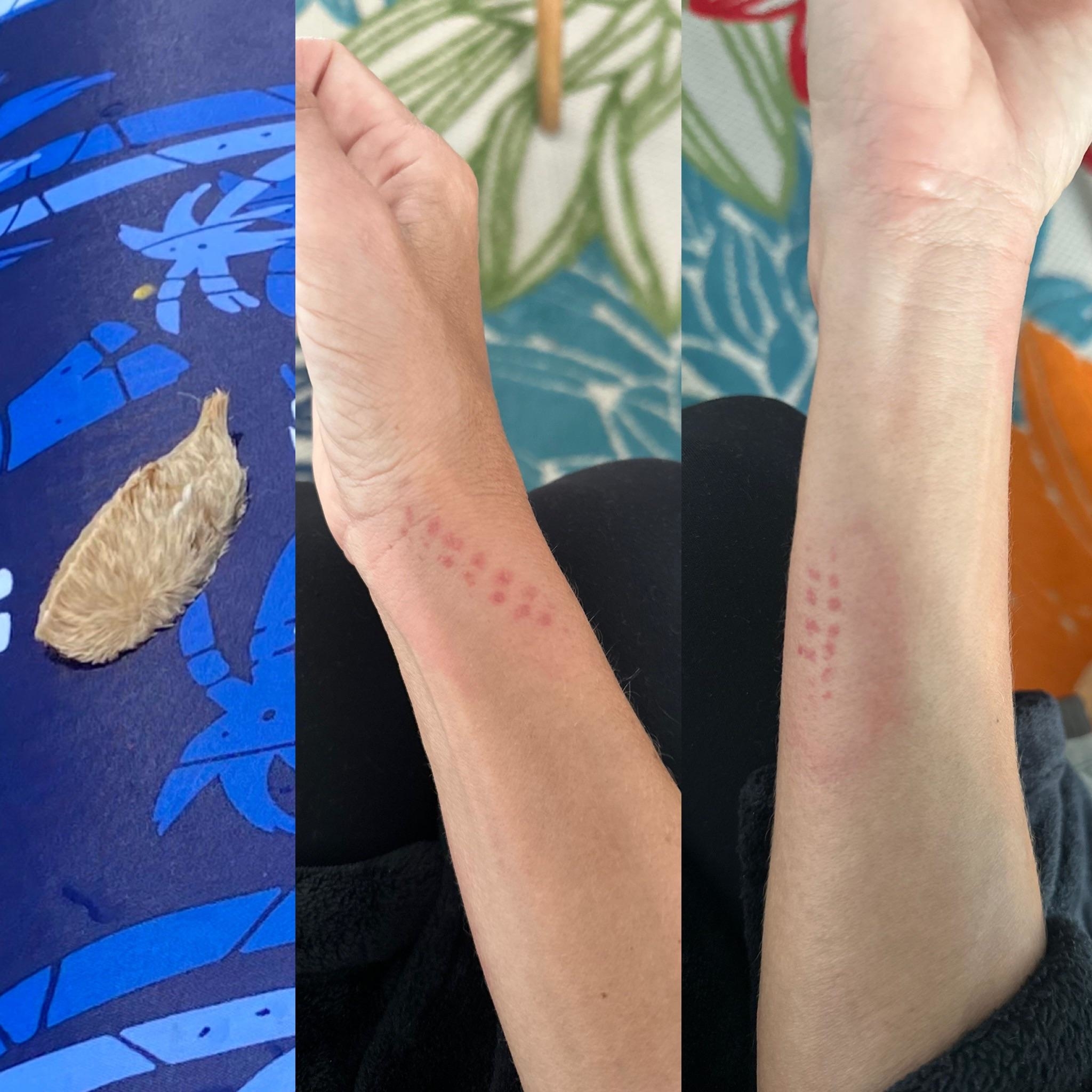 A person&#x27;s arm marks where they brushed against a puss caterpillar