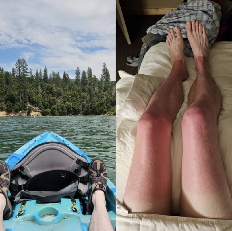A person with bad sunburn on their legs