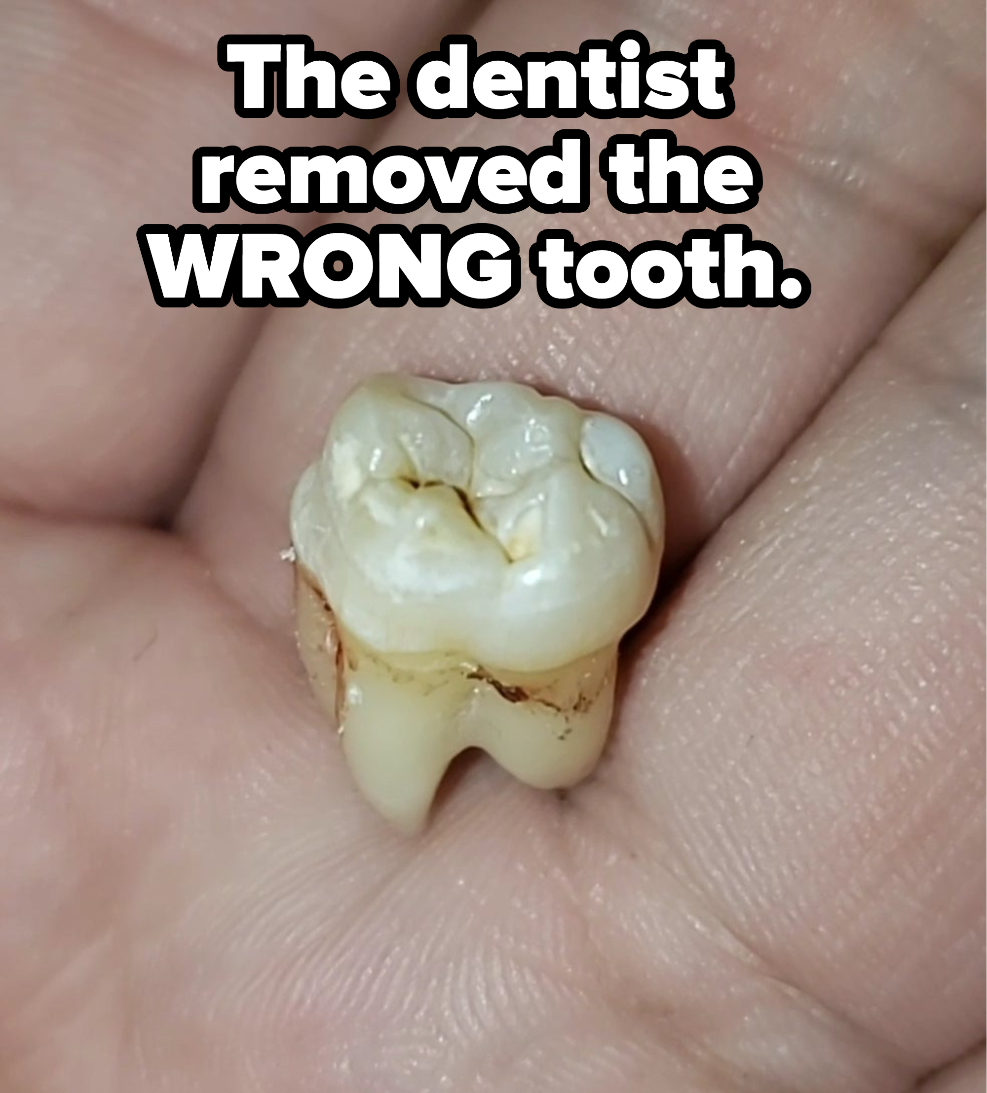 A tooth in the palm of a hand with the caption &quot;My dentist removed the wrong tooth&quot;