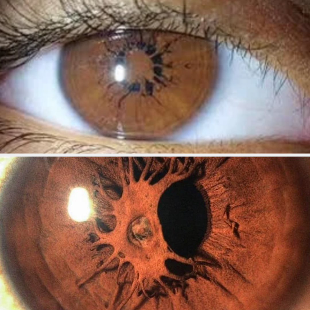 Close-up of iris material growing over pupil