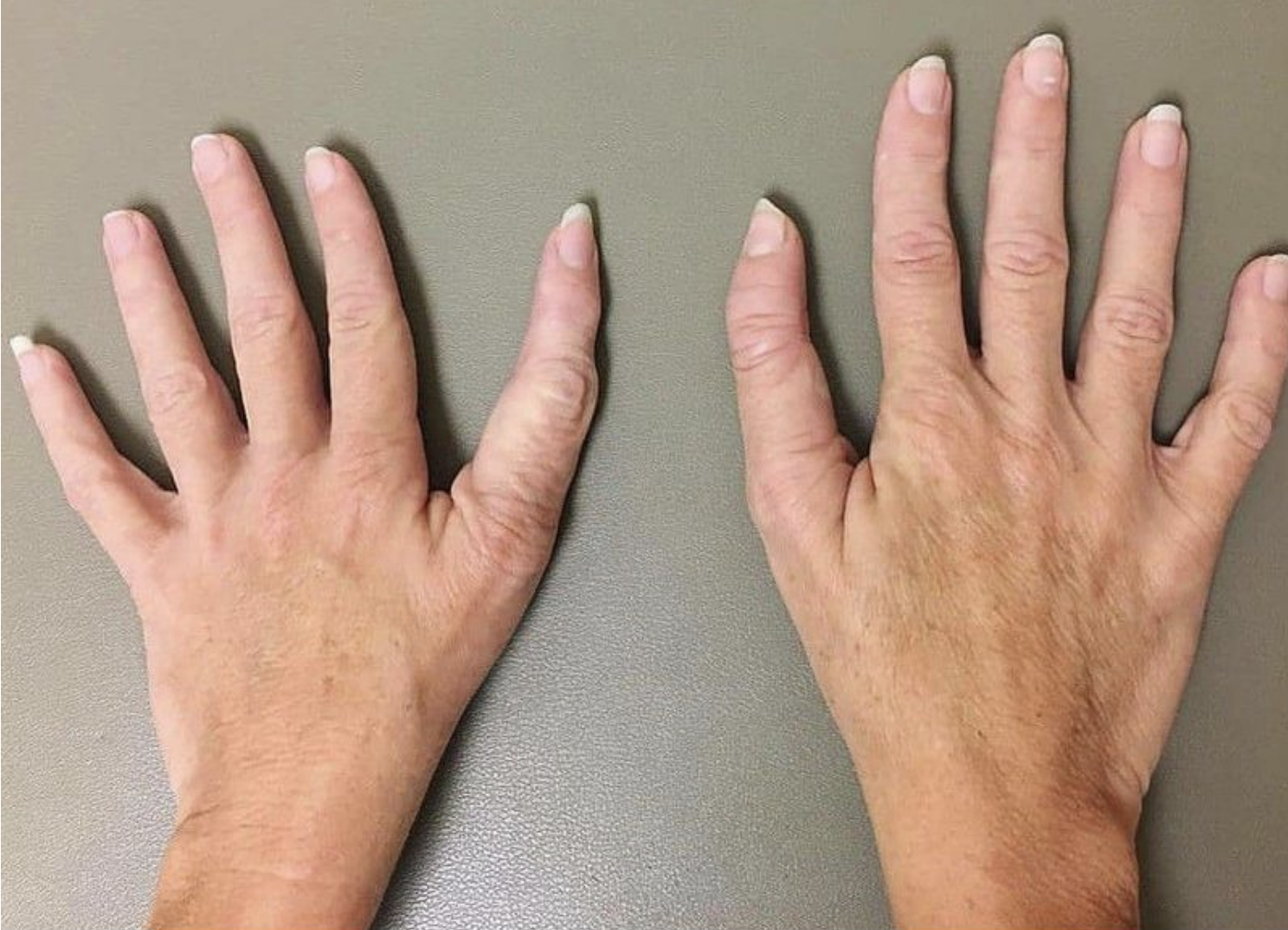 Two hands with very long thumbs