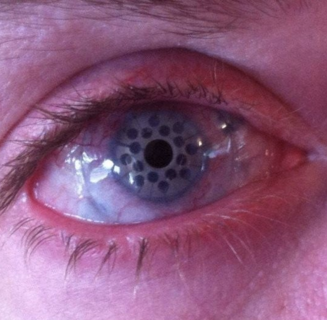 An eye with what looks like a porous iris