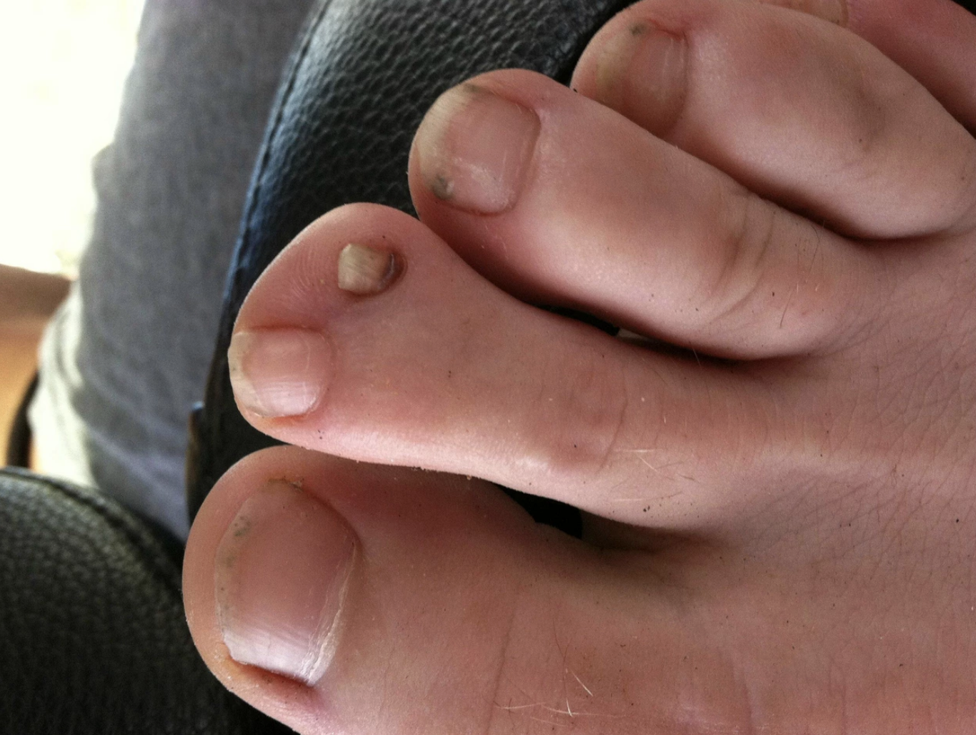 Two small toenails on one larger toe, with no nail in the center