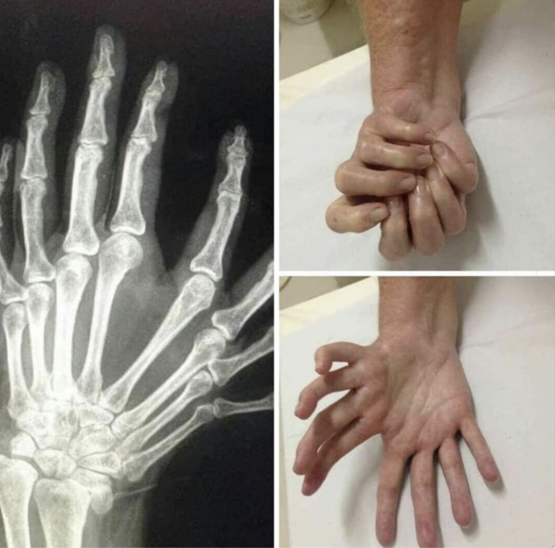 X-ray of the &quot;double&quot; hand, which has eight fingers
