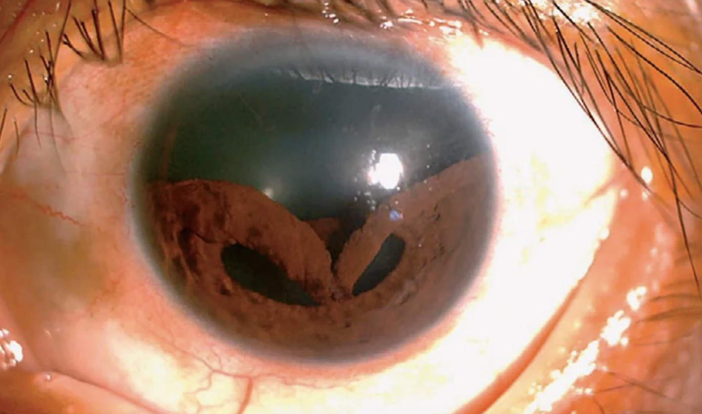 Iris material collecting at bottom of pupil