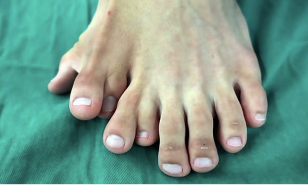 A human foot with nine toes
