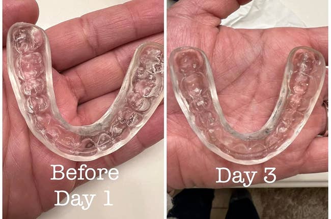 Reviewer's photo of a retainer before and after using the retainer cleaning tablets