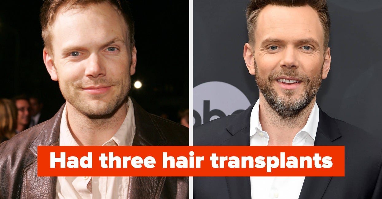Male Celebs Discuss Hair Transplants and Wigs