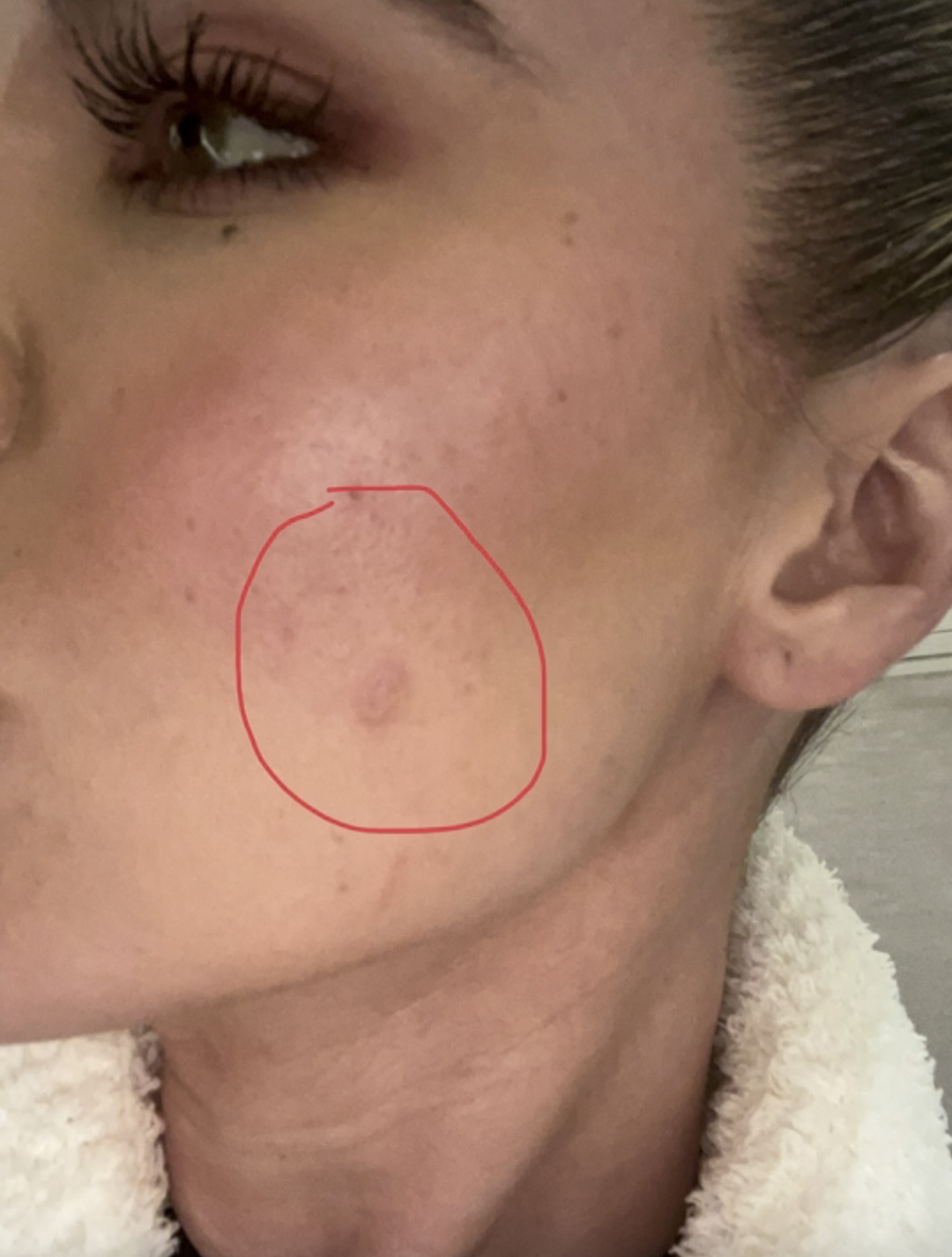 circle drawn around the spot on her face