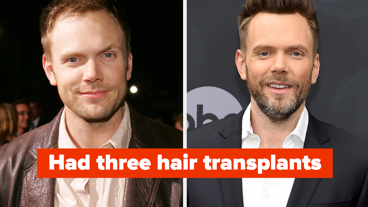 10 celebrities speaking candidly about hair loss